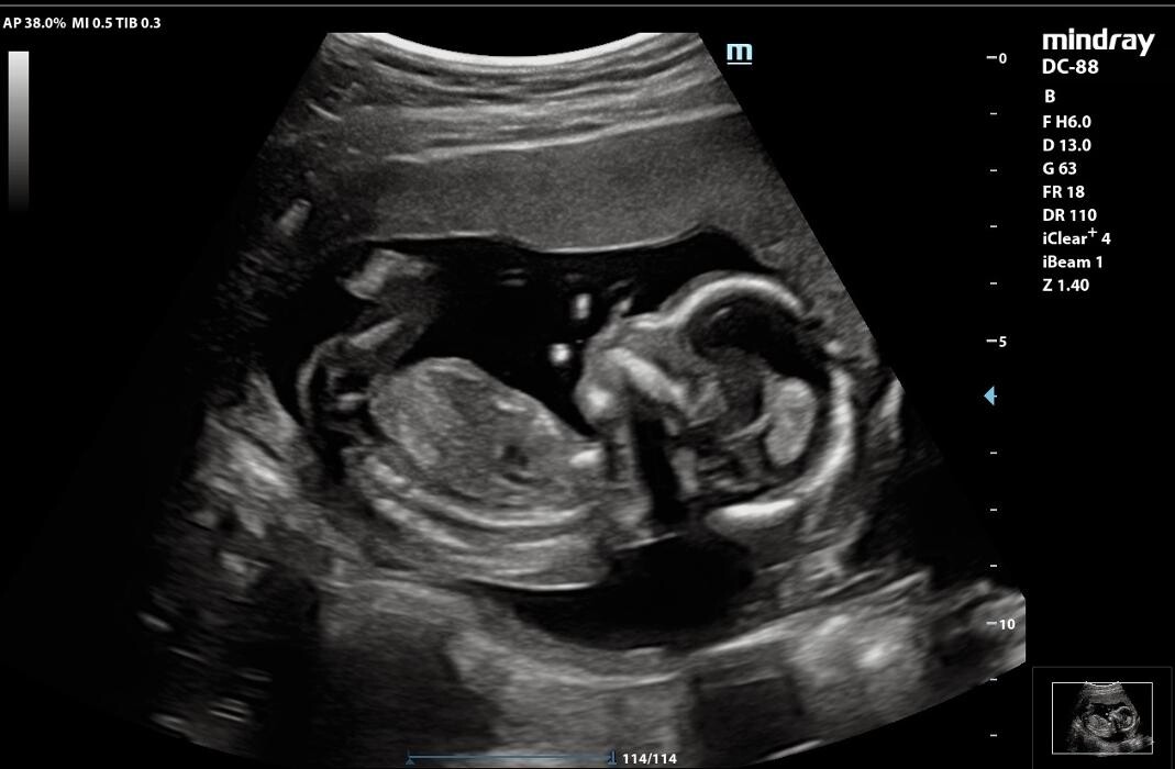 Images UC Baby Winnipeg (Previous Fetoscan)