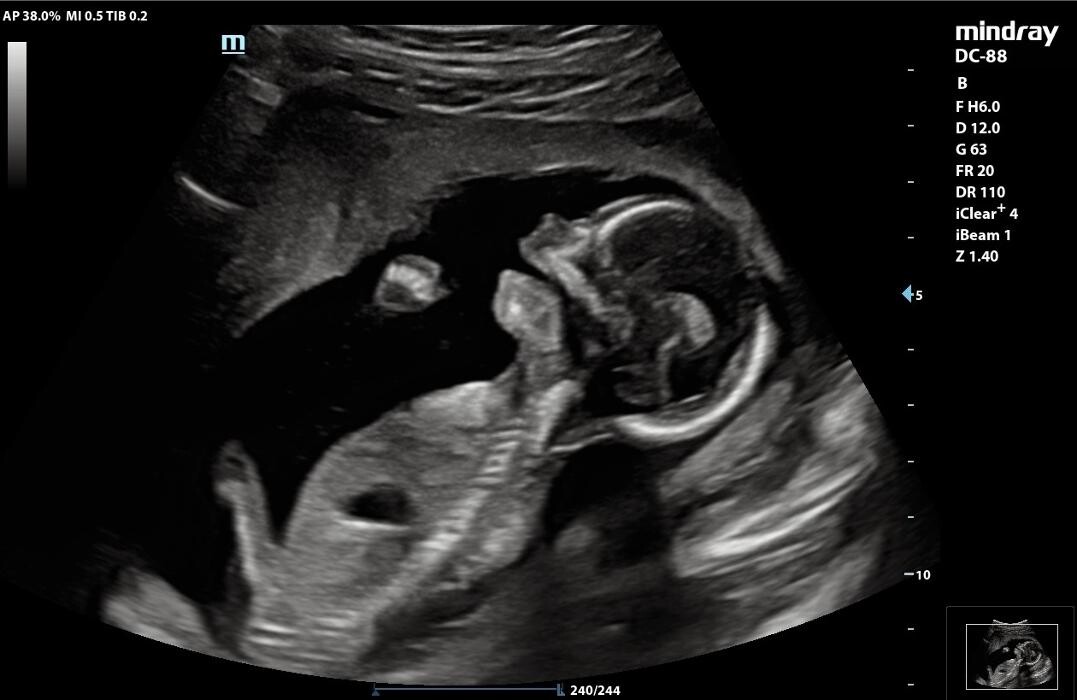 Images UC Baby Winnipeg (Previous Fetoscan)