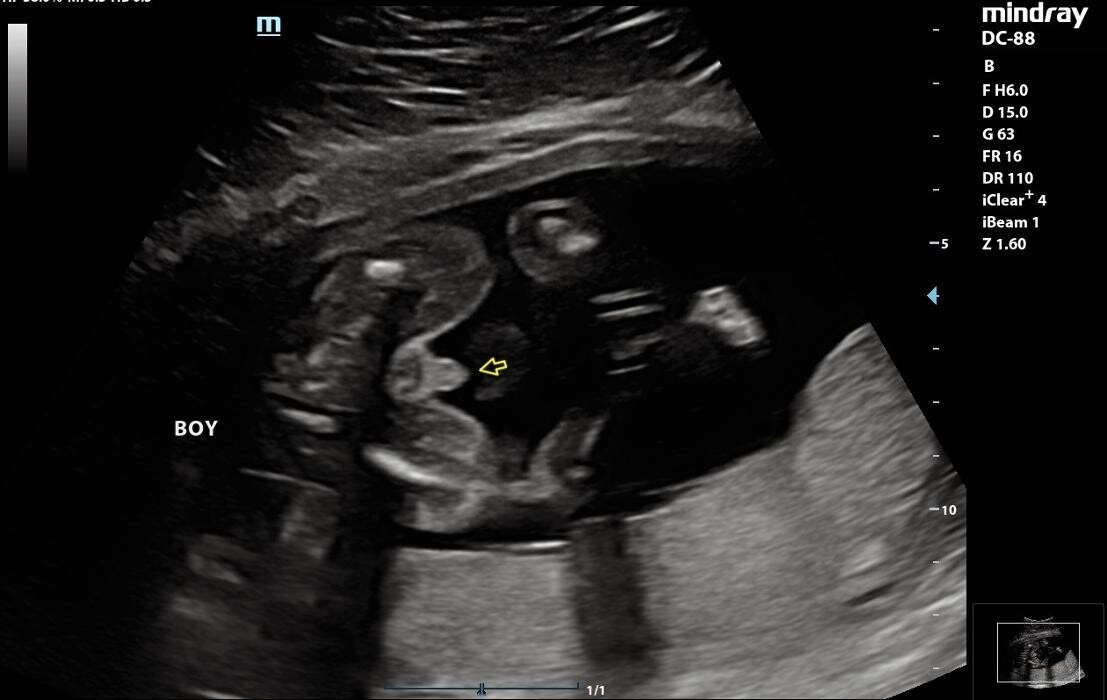 Images UC Baby Winnipeg (Previous Fetoscan)