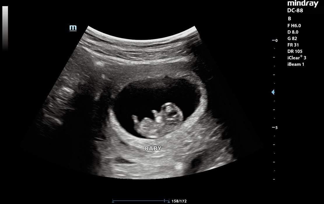Images UC Baby Winnipeg (Previous Fetoscan)