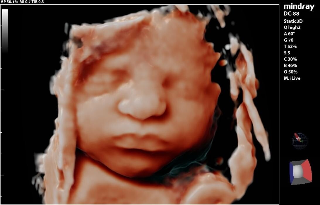 Images UC Baby Winnipeg (Previous Fetoscan)