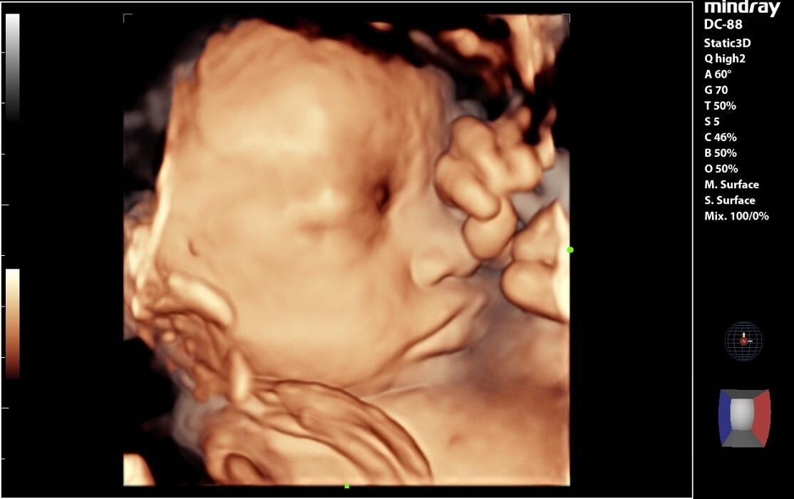 Images UC Baby Winnipeg (Previous Fetoscan)