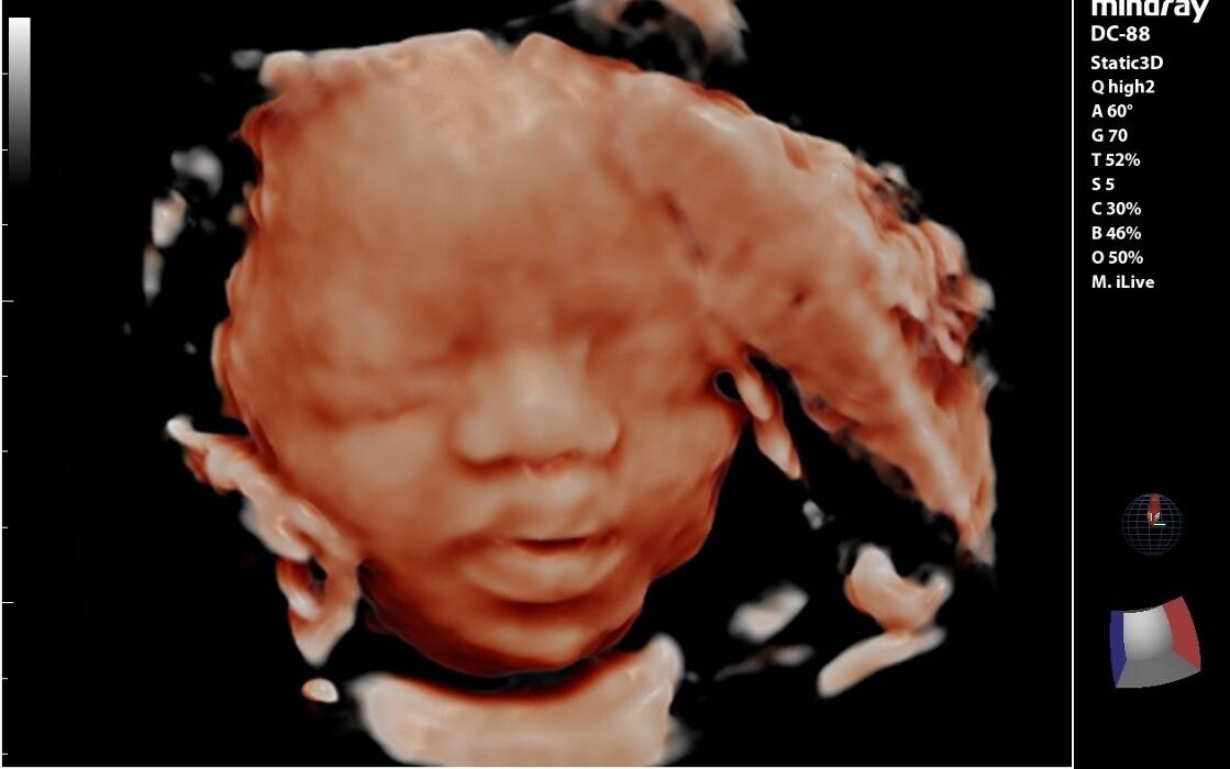 Images UC Baby Winnipeg (Previous Fetoscan)
