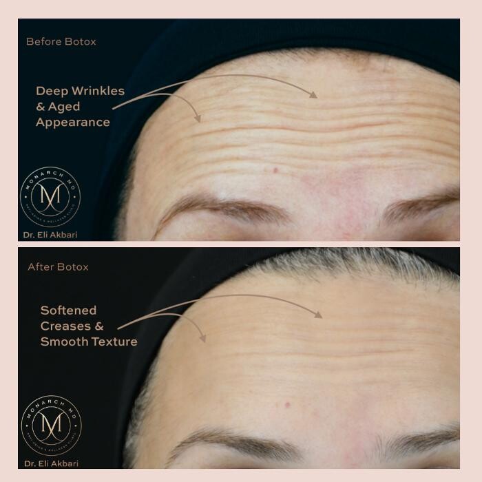 Images Monarch MD Medical Aesthetics by Dr. Eli Akbari, MD, FRCSC.