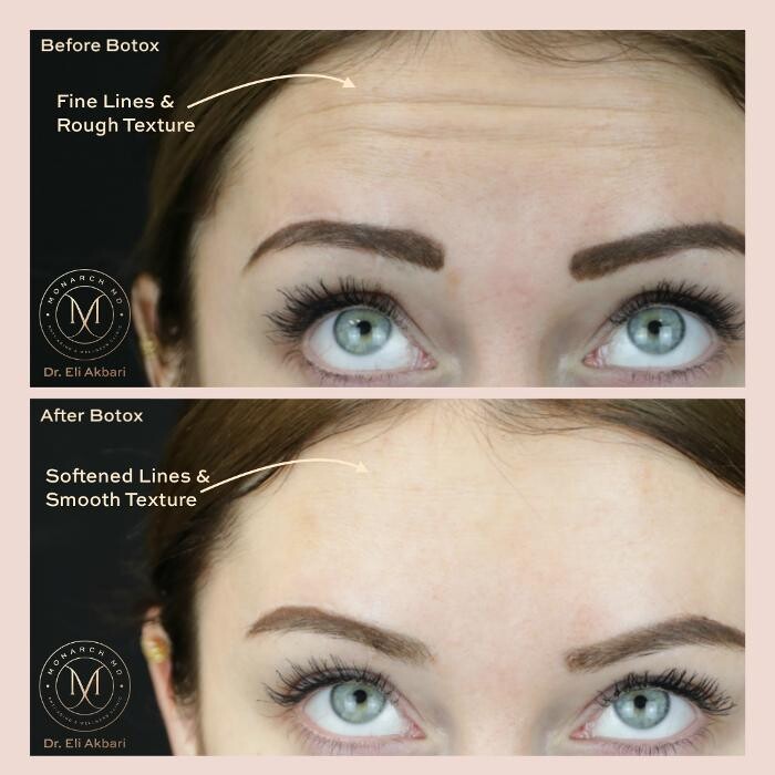 Images Monarch MD Medical Aesthetics by Dr. Eli Akbari, MD, FRCSC.