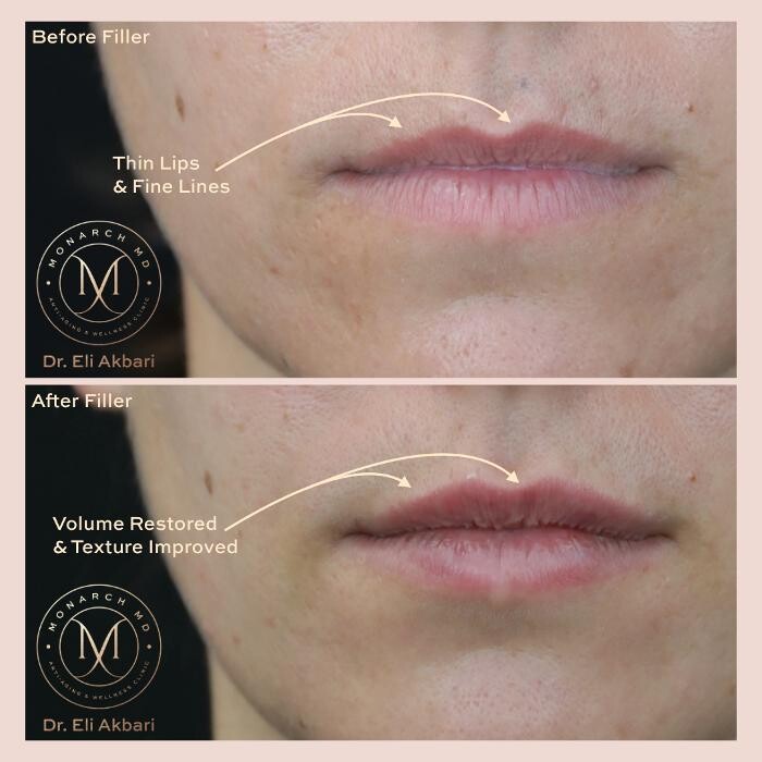Images Monarch MD Medical Aesthetics by Dr. Eli Akbari, MD, FRCSC.