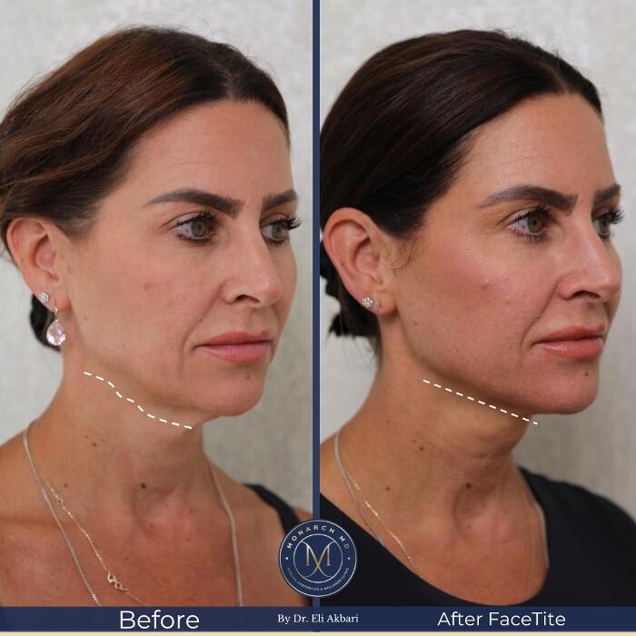 Images Monarch MD Medical Aesthetics by Dr. Eli Akbari, MD, FRCSC.