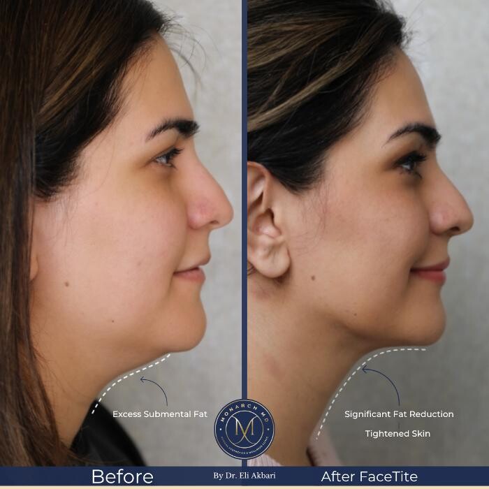 Images Monarch MD Medical Aesthetics by Dr. Eli Akbari, MD, FRCSC.