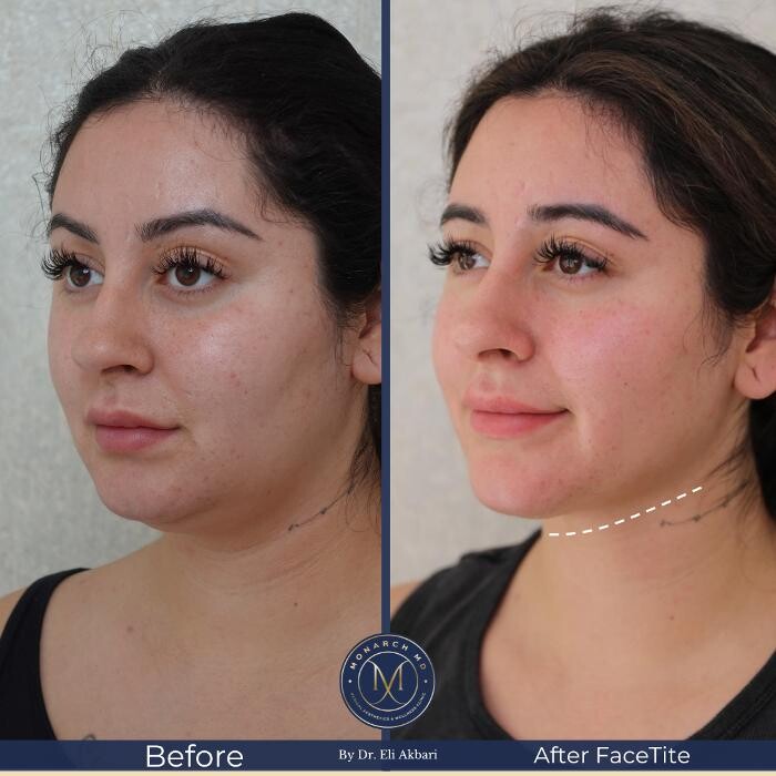 Images Monarch MD Medical Aesthetics by Dr. Eli Akbari, MD, FRCSC.