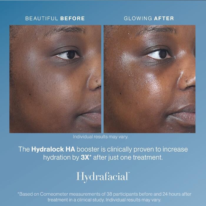 Images Mélanie Duchesneau -Hydrafacial
