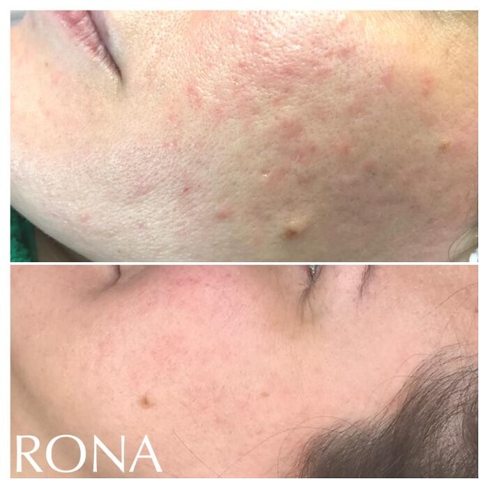 Bilder RONA medical cosmetics