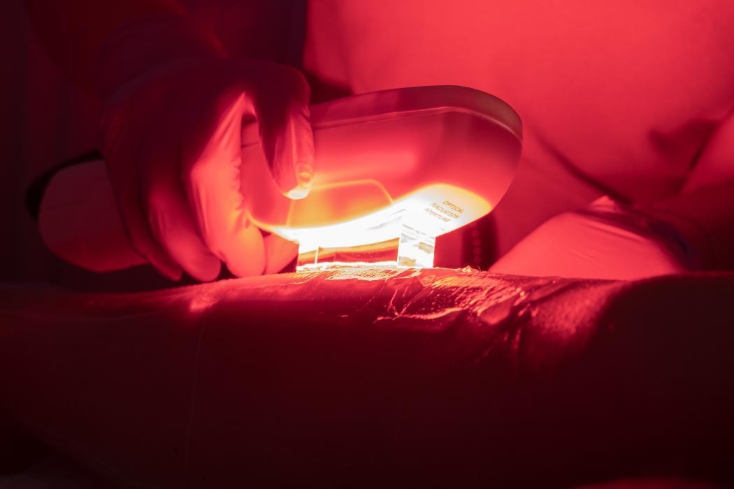 Bilder Haarentfernung Erding - Hairless Skin