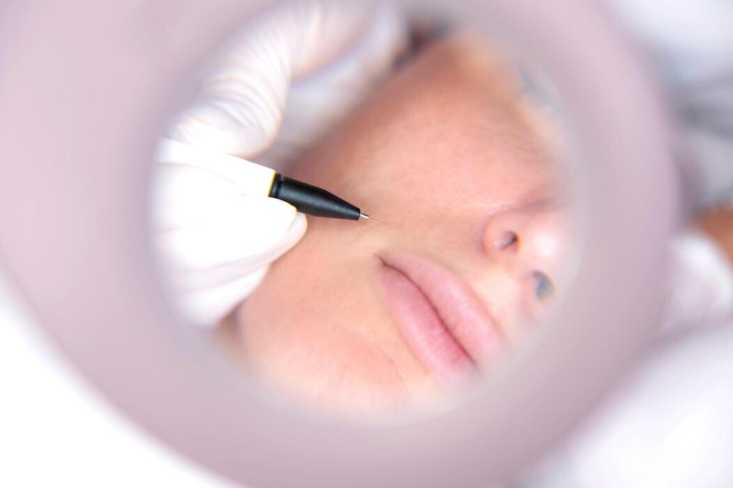 Bilder simplyhairless by PurePulse Fachzentrum Mannheim