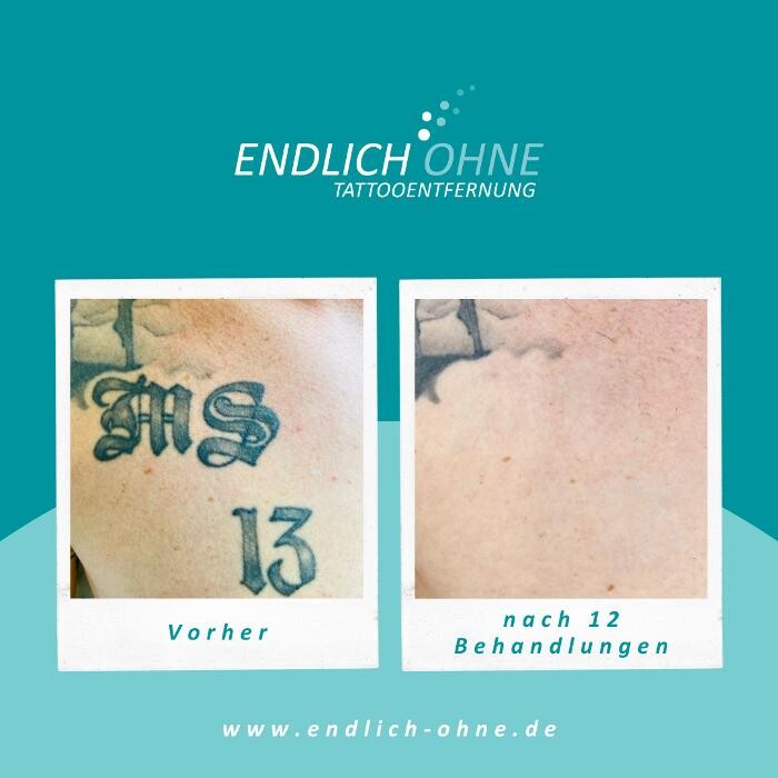 Bilder ENDLICH OHNE Tattooentfernung Filiale Bremen