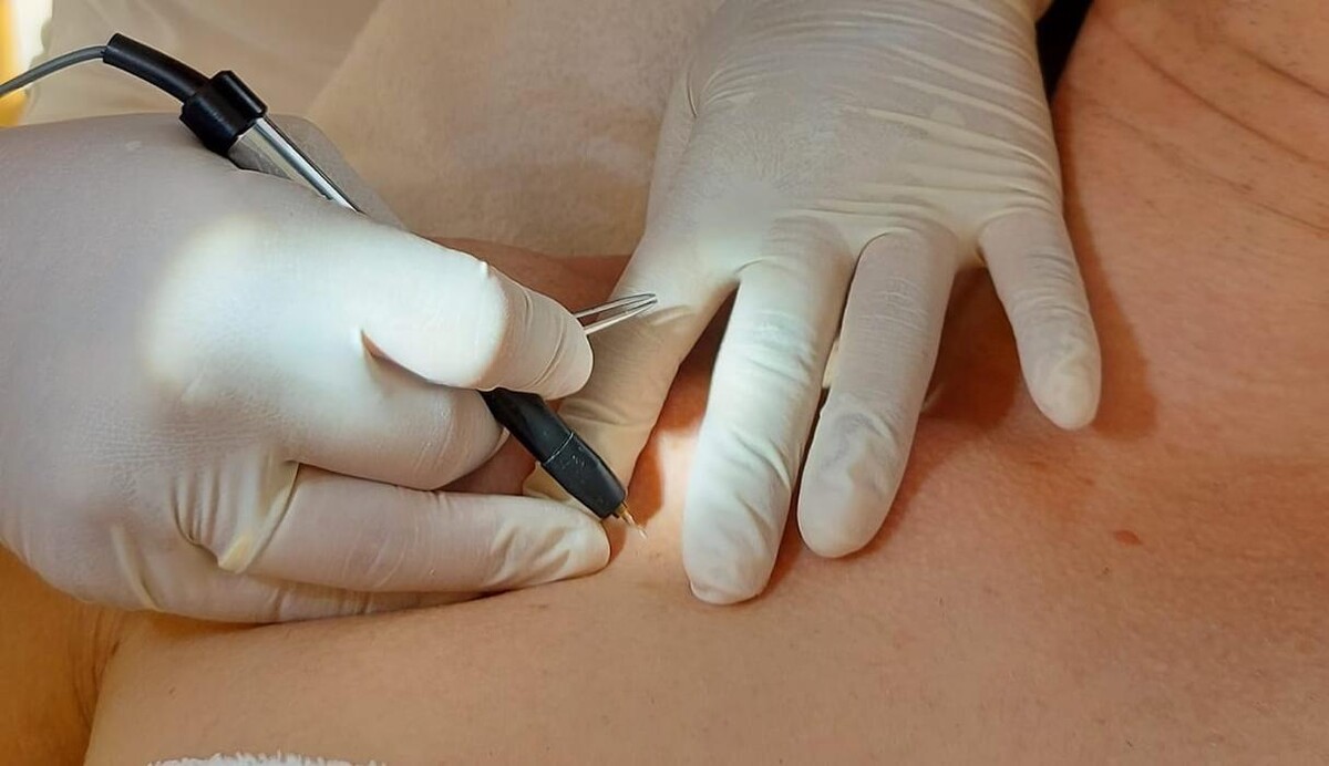 Bilder Casana Augsburg - Dauerhafte Haarentfernung & Microneedling