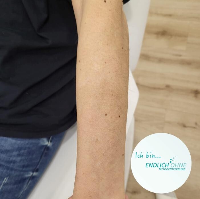 Bilder ENDLICH OHNE Tattooentfernung Filiale Kassel