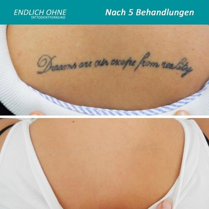 Bilder ENDLICH OHNE Tattooentfernung Filiale Dresden/Pirna