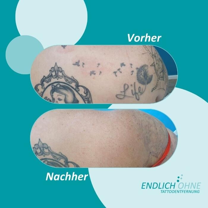 Bilder ENDLICH OHNE Tattooentfernung Filiale Bamberg