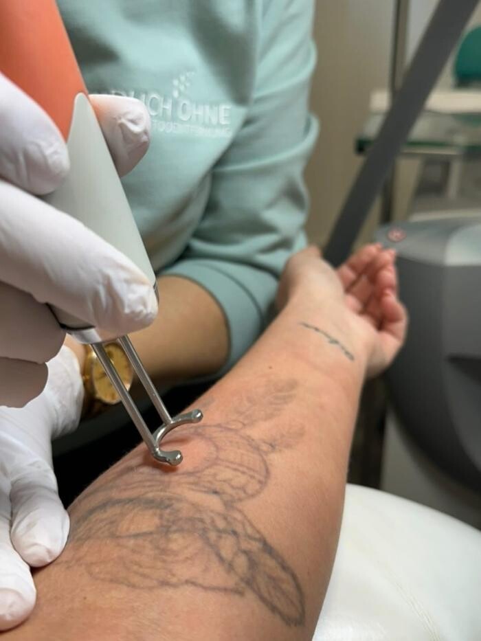 Bilder ENDLICH OHNE Tattooentfernung Filiale Bamberg