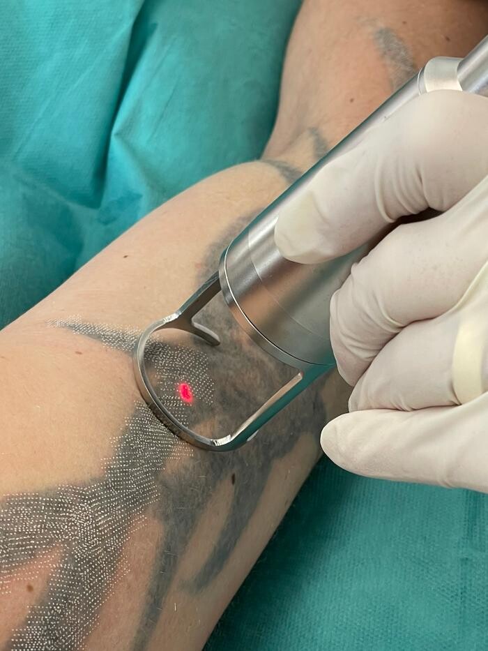 Bilder ENDLICH OHNE Tattooentfernung Filiale Wolfenbüttel