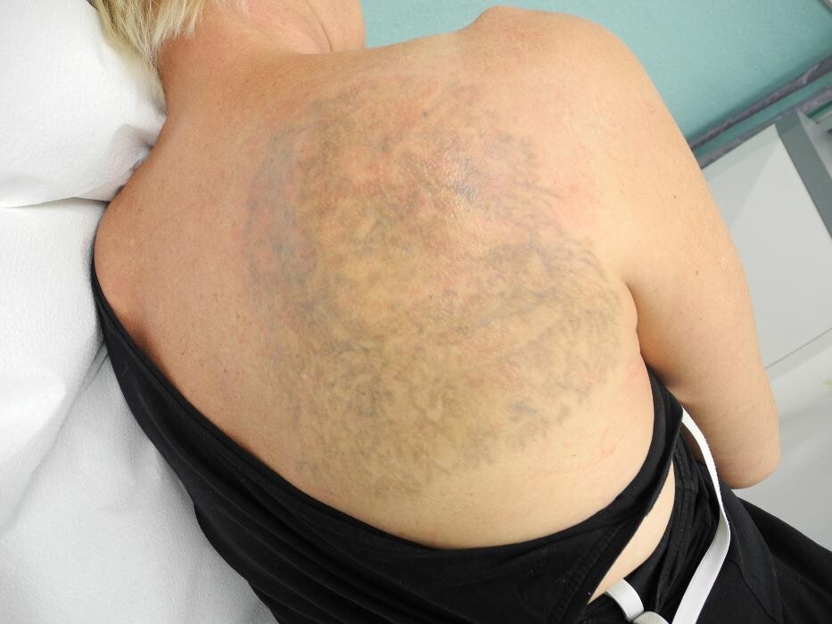Bilder ENDLICH OHNE Tattooentfernung Filiale Hannover