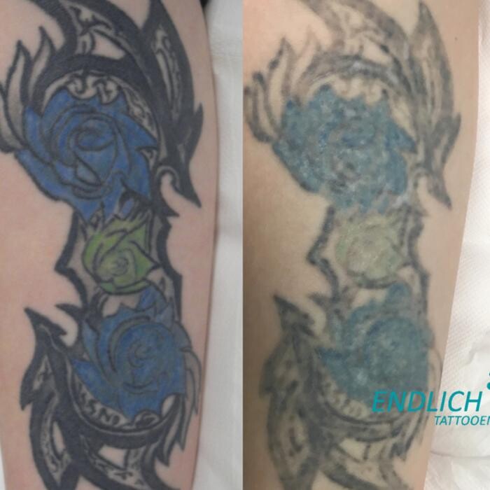 Bilder ENDLICH OHNE Tattooentfernung Filiale Hannover