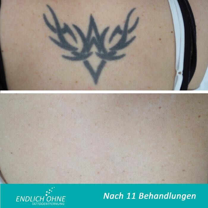 Bilder ENDLICH OHNE Tattooentfernung Filiale Hannover