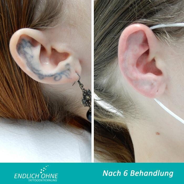 Bilder ENDLICH OHNE Tattooentfernung Filiale Hannover