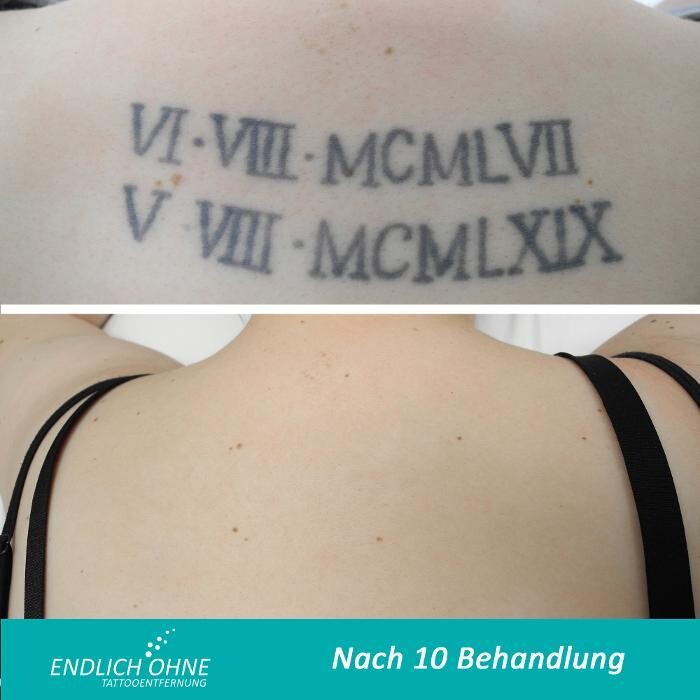 Bilder ENDLICH OHNE Tattooentfernung Filiale Hannover