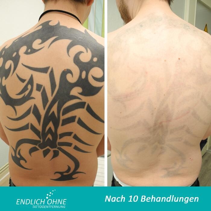 Bilder ENDLICH OHNE Tattooentfernung Filiale Hannover