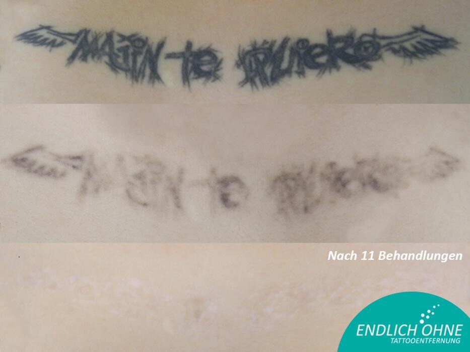 Bilder ENDLICH OHNE Tattooentfernung Filiale Hannover