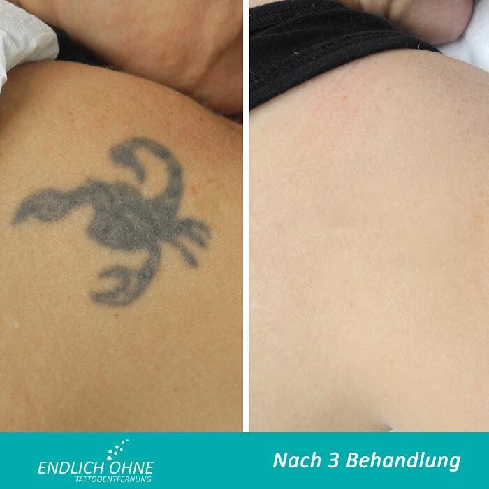 Bilder ENDLICH OHNE Tattooentfernung Filiale Hannover