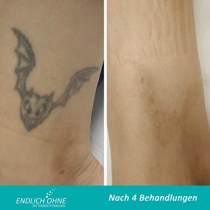 Bilder ENDLICH OHNE Tattooentfernung Filiale Hannover