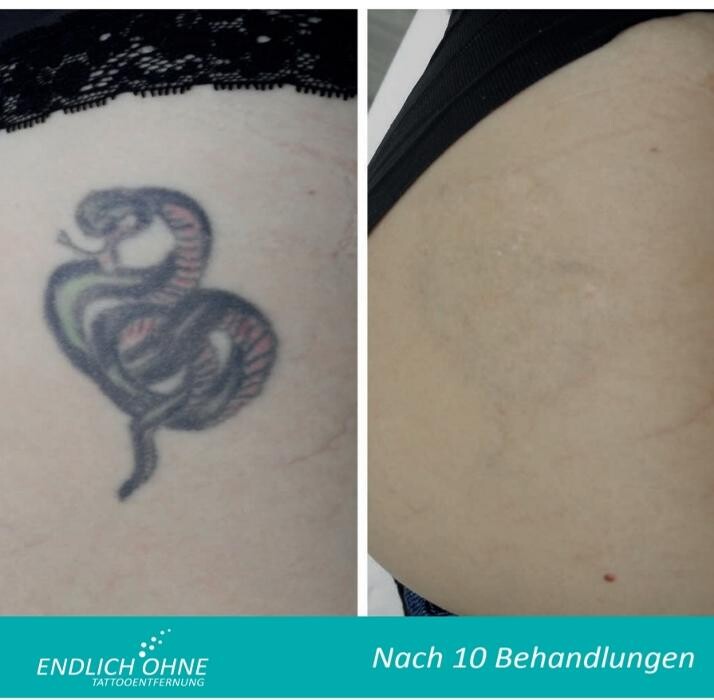 Bilder ENDLICH OHNE Tattooentfernung Filiale Hannover