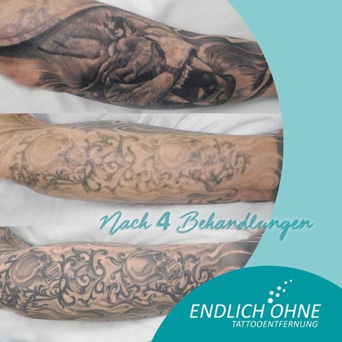Bilder ENDLICH OHNE Tattooentfernung Filiale Wilhelmshaven