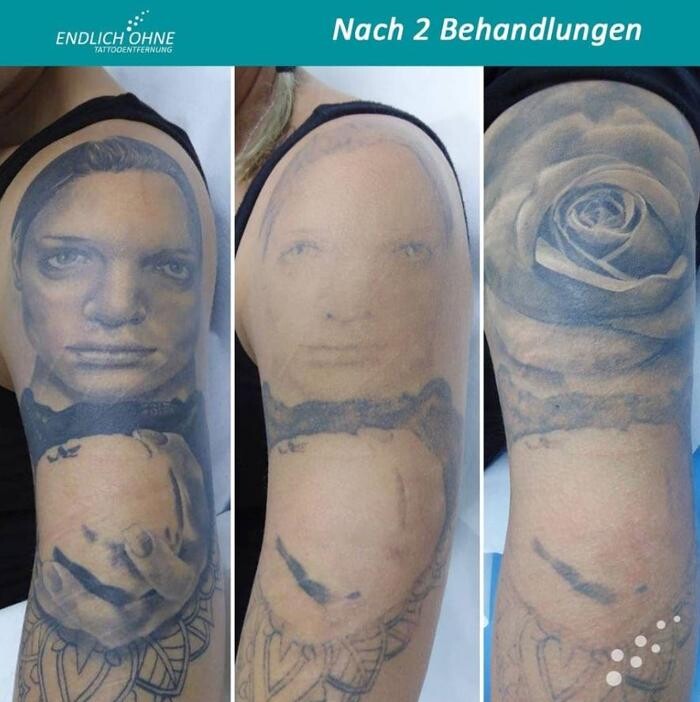 Bilder ENDLICH OHNE Tattooentfernung Filiale Landshut