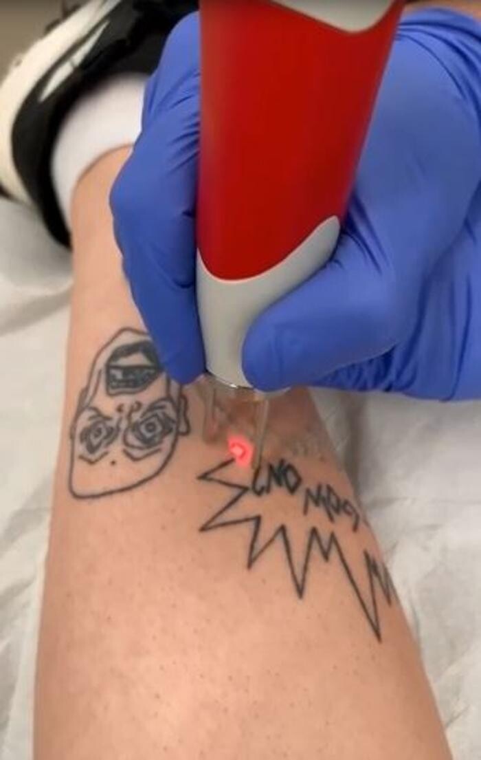 Bilder ENDLICH OHNE Tattooentfernung Filiale Berlin