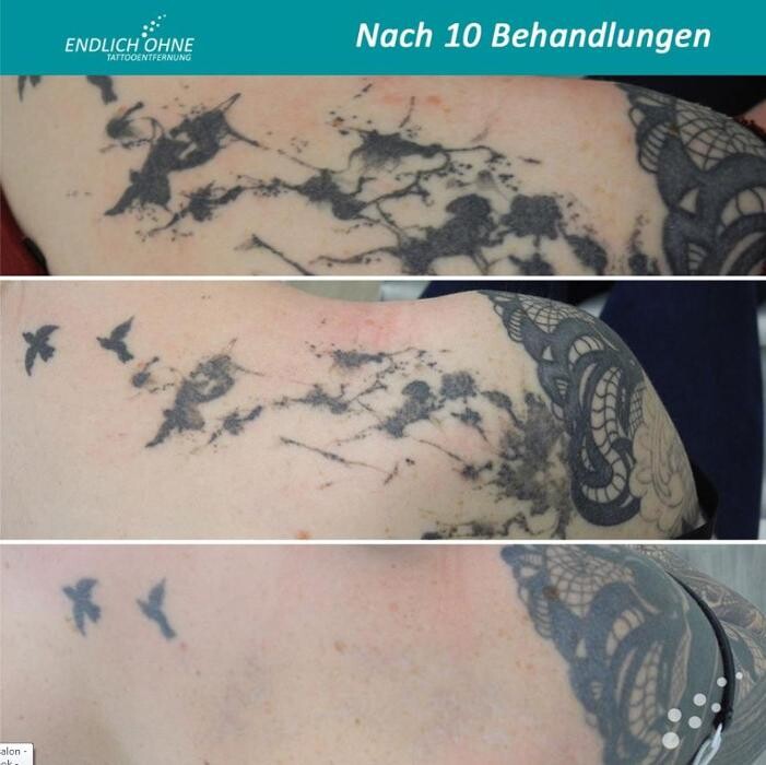 Bilder ENDLICH OHNE Tattooentfernung Filiale Berlin