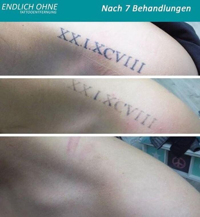 Bilder ENDLICH OHNE Tattooentfernung Filiale Berlin