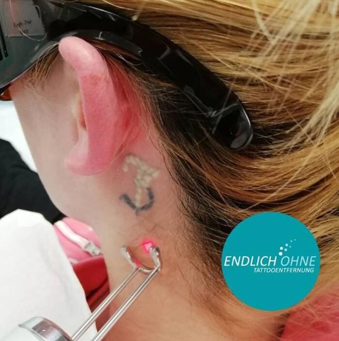 Bilder ENDLICH OHNE Tattooentfernung Filiale Mainz / Wiesbaden