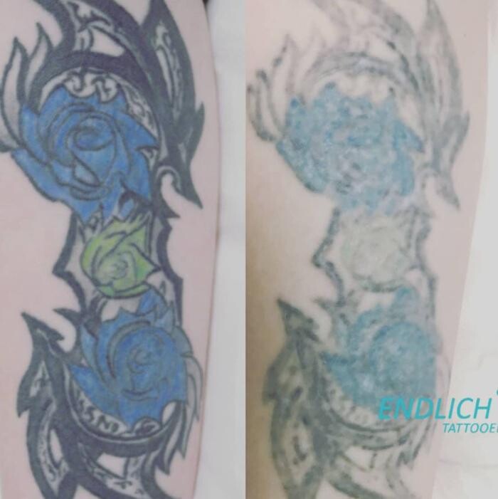Bilder ENDLICH OHNE Tattooentfernung Filiale Heilbronn