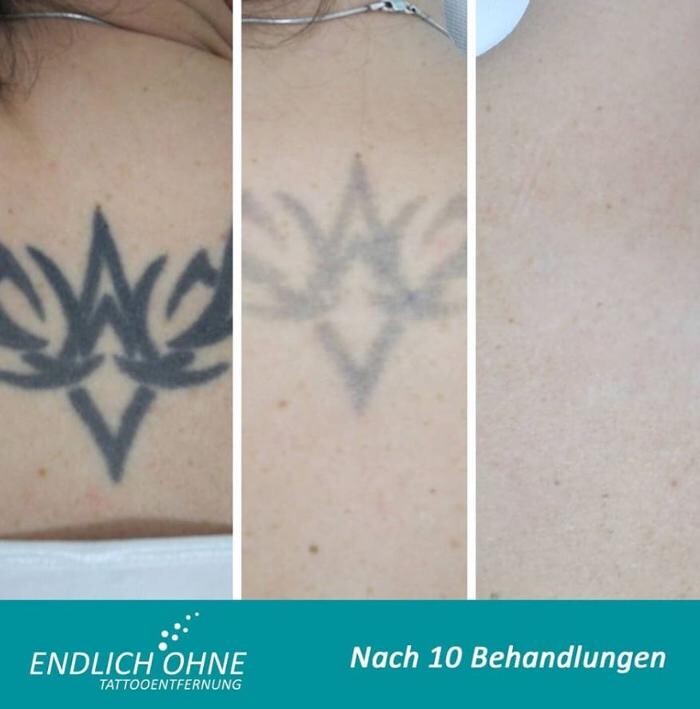 Bilder ENDLICH OHNE Tattooentfernung Filiale Heilbronn