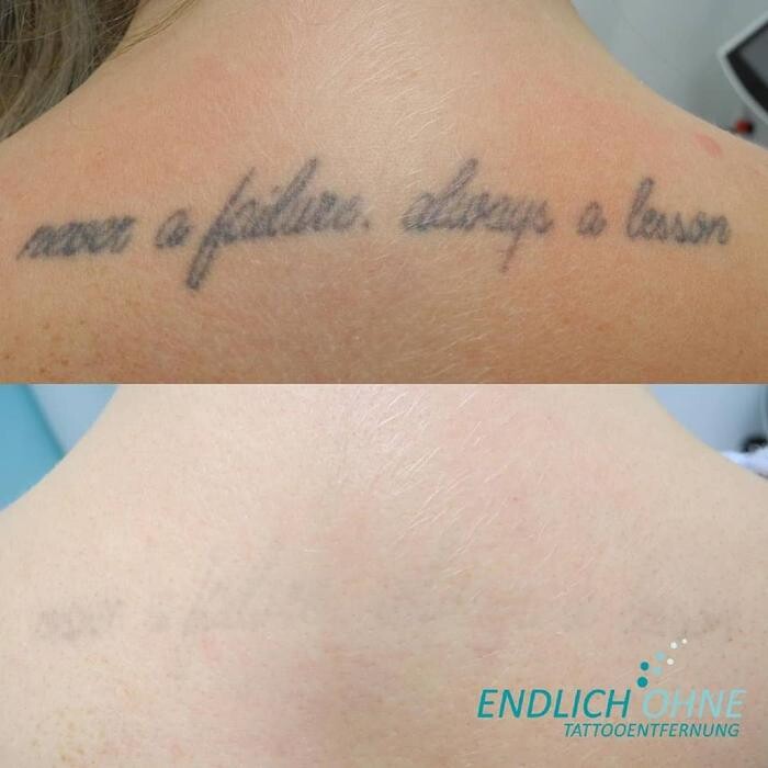Bilder ENDLICH OHNE Tattooentfernung Filiale Fulda