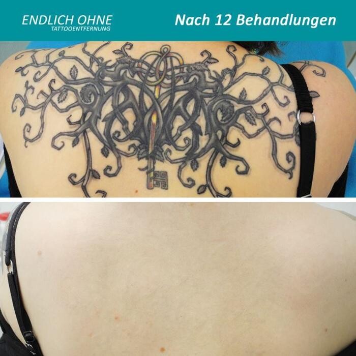 Bilder ENDLICH OHNE Tattooentfernung Filiale Saarbrücken