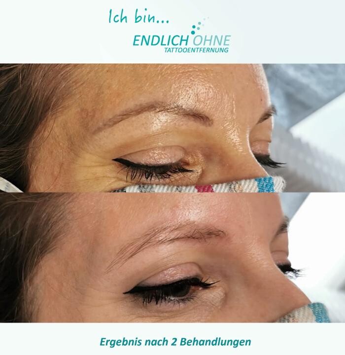 Bilder ENDLICH OHNE Tattooentfernung Filiale Lauchringen