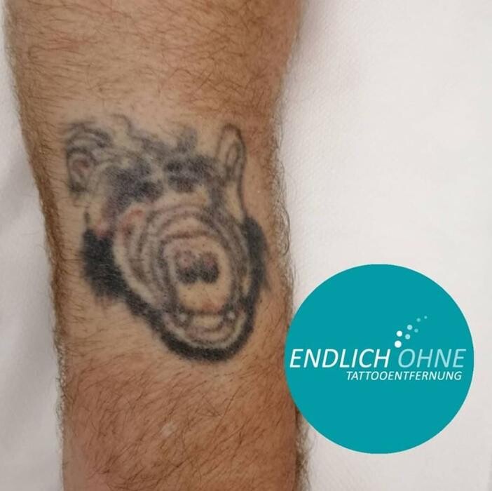 Bilder ENDLICH OHNE Tattooentfernung Filiale Lauchringen
