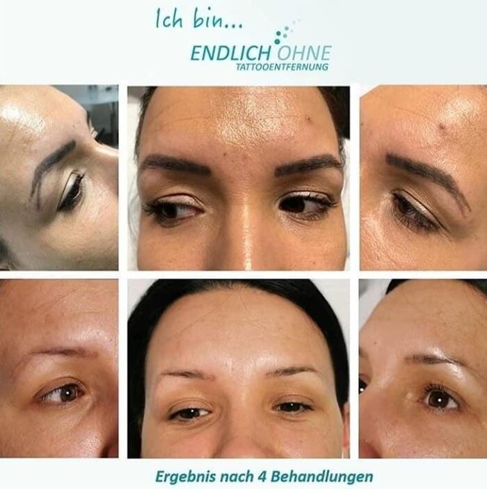 Bilder ENDLICH OHNE Tattooentfernung Filiale Lauchringen