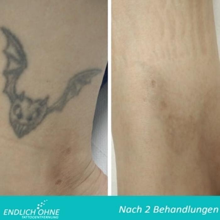 Bilder ENDLICH OHNE Tattooentfernung Filiale Kiel