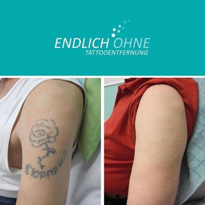 Bilder ENDLICH OHNE Tattooentfernung Filiale Karlsruhe