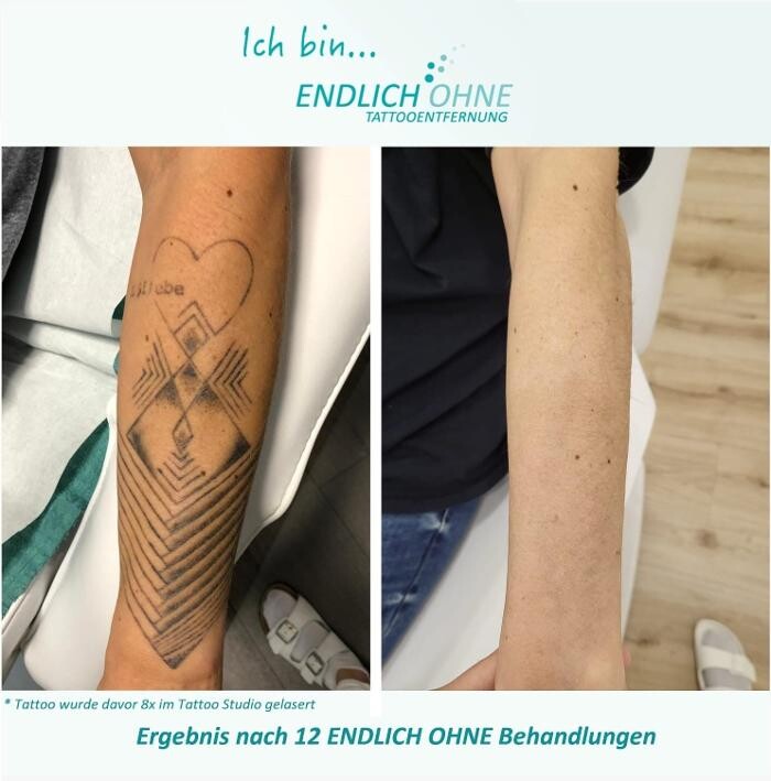 Bilder ENDLICH OHNE Tattooentfernung Filiale Karlsruhe